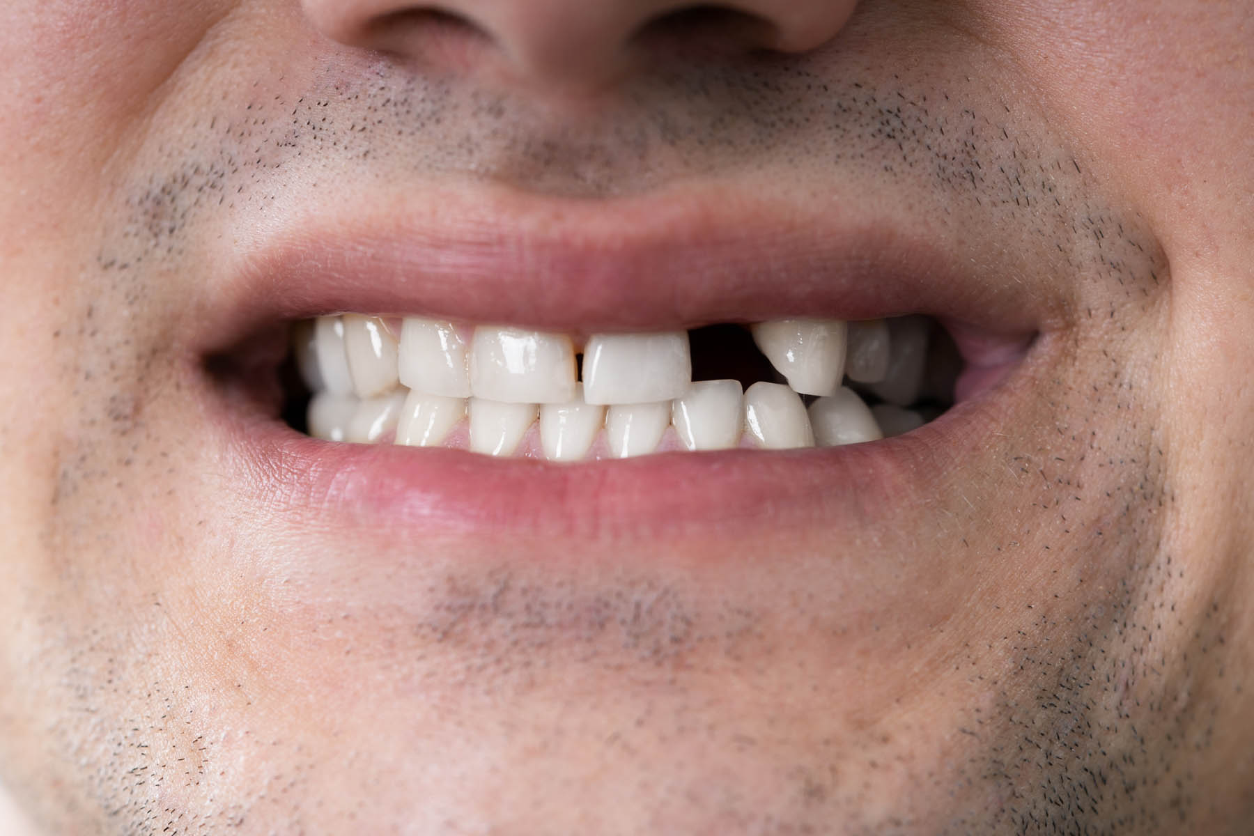 What is the Best Option for Replacing Missing Teeth?