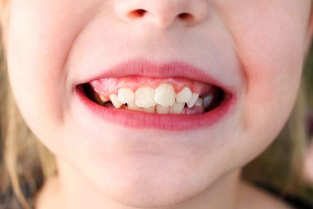 What-Causes-Tooth-Crowding